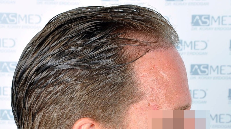 Norwood3 2450-grafts-FUE before Before%204_V2