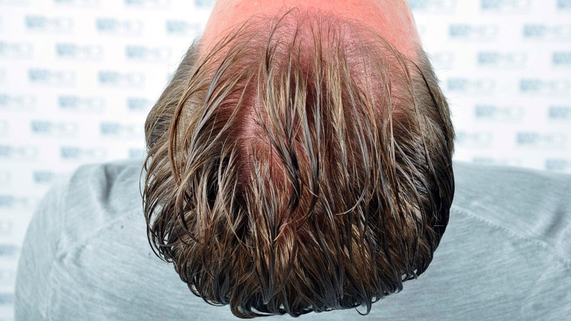 Norwood3 2450-grafts-FUE before _Before%205_V2