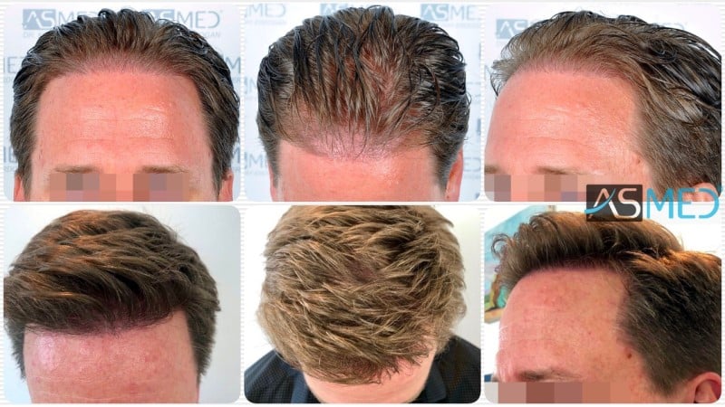 2450-grafts-FUE gallery
