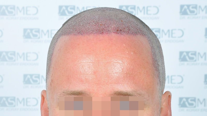 Norwood3 2450-grafts-FUE operation Operation%201_V2