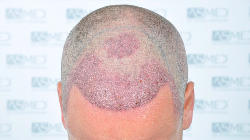 Norwood3 2450-grafts-FUE operation Operation%202_V2