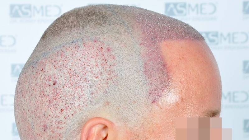 Norwood3 2450-grafts-FUE operation Operation%204_V2