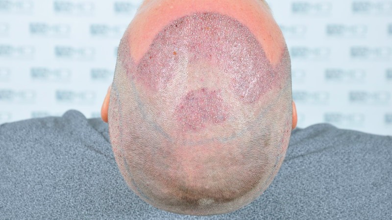 Norwood3 2450-grafts-FUE operation Operation%205_V2