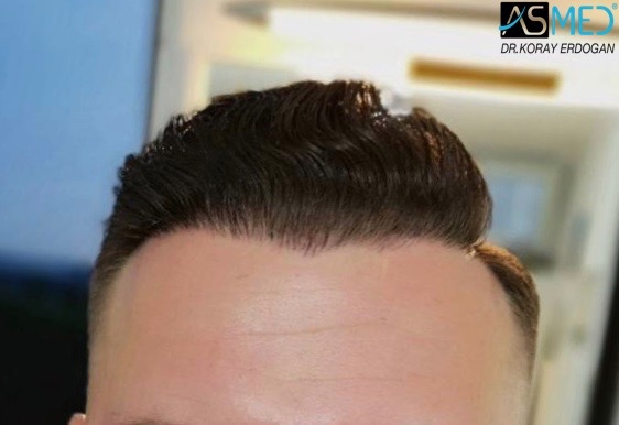 Norwood3 2617-grafts-FUE 18months 1_new