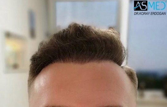 Norwood3 2617-grafts-FUE 18months 2_new