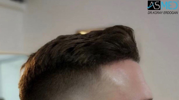 Norwood3 2617-grafts-FUE 18months 3_new