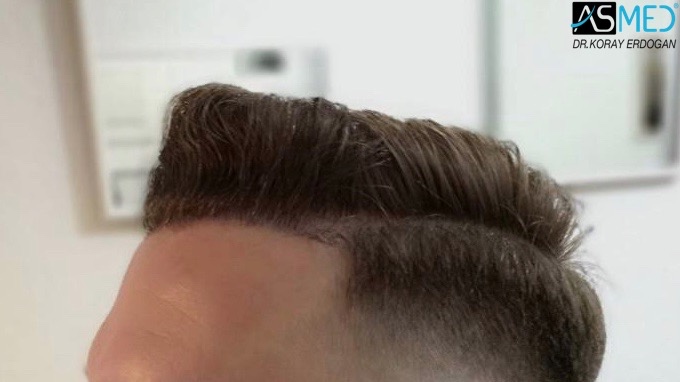 Norwood3 2617-grafts-FUE 18months 4_new