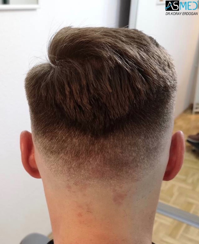 Norwood3 2617-grafts-FUE 18months 6_new