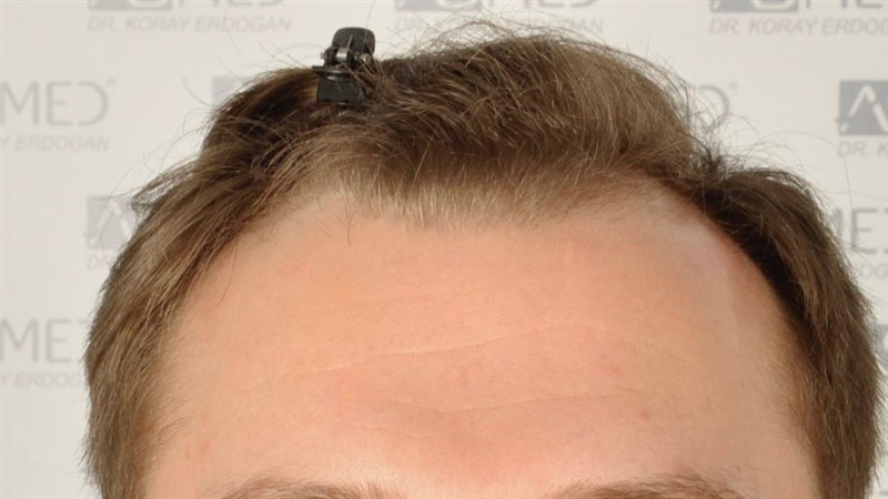 Norwood3 2617-grafts-FUE before 1