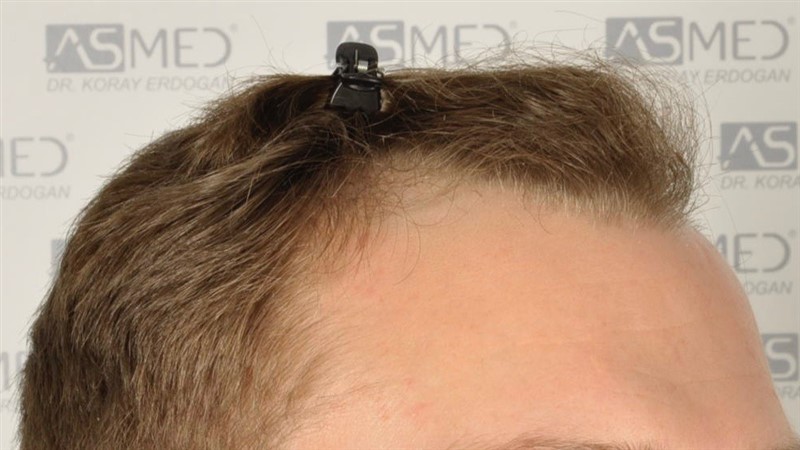 Norwood3 2617-grafts-FUE before 2