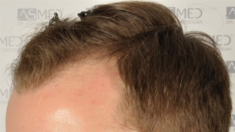 Norwood3 2617-grafts-FUE before 3
