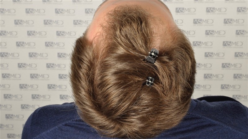 Norwood3 2617-grafts-FUE before 4