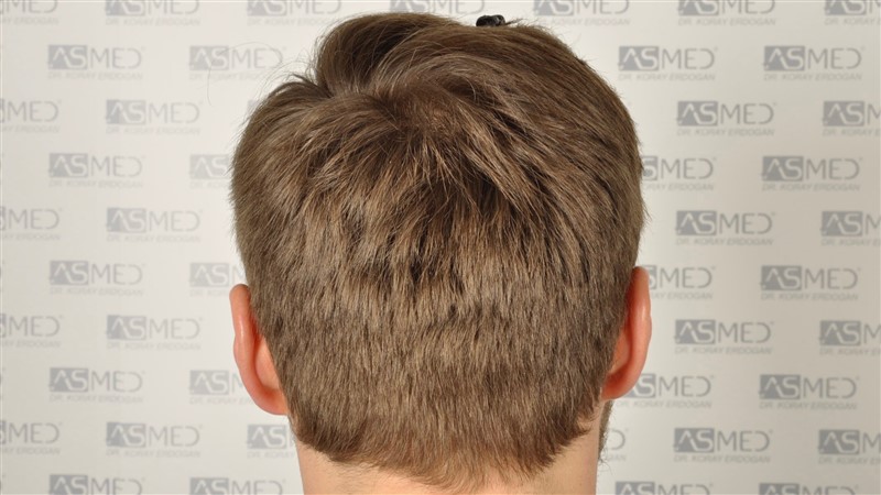 Norwood3 2617-grafts-FUE before 5