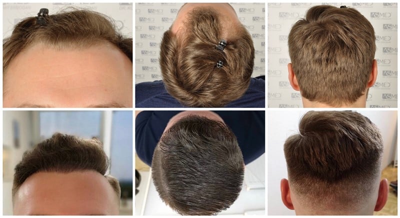 2617-grafts-FUE gallery