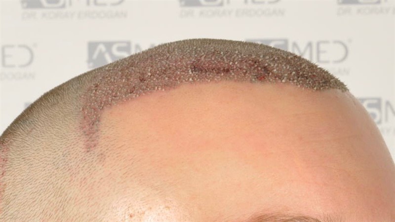 Norwood3 2617-grafts-FUE operation 2