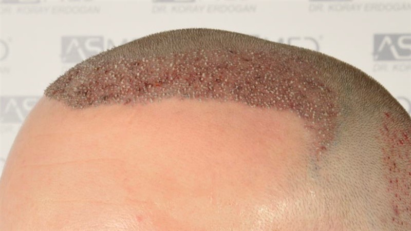 Norwood3 2617-grafts-FUE operation 3