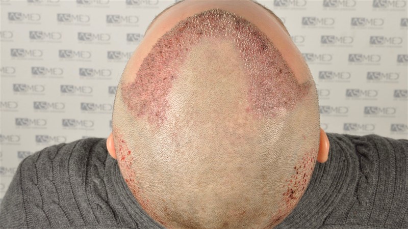Norwood3 2617-grafts-FUE operation 4