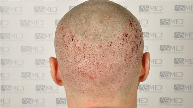 Norwood3 2617-grafts-FUE operation 5