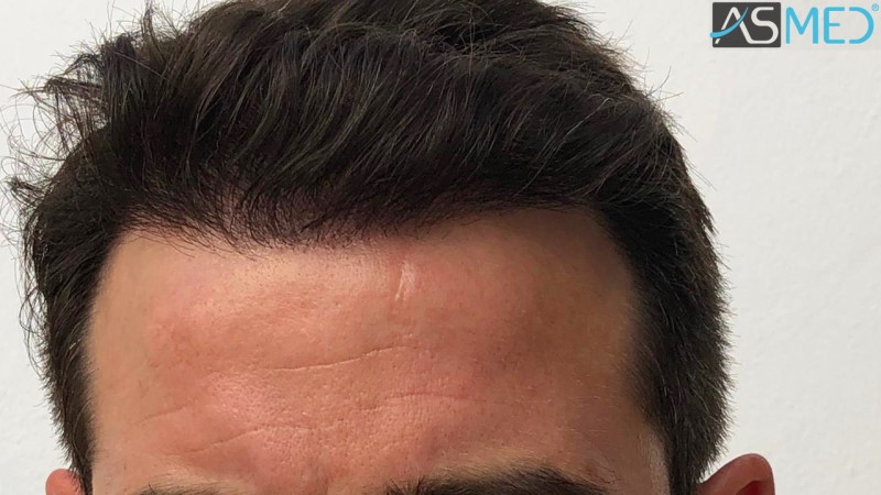 Norwood3 2625-grafts-FUE 10months 2