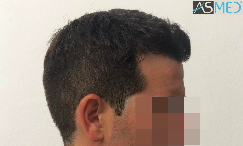 Norwood3 2625-grafts-FUE 10months 5