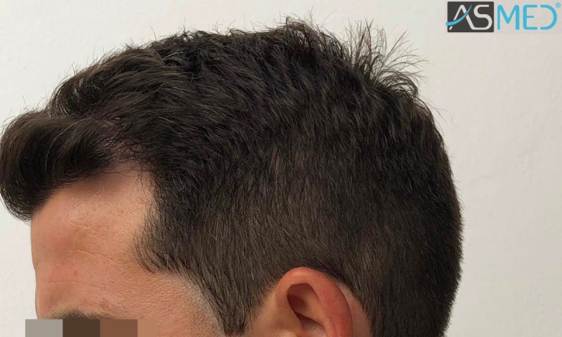 Norwood3 2625-grafts-FUE 10months 6