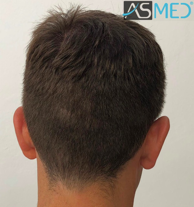 Norwood3 2625-grafts-FUE 10months 7