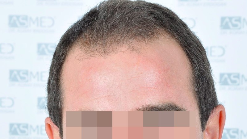 Norwood3 2625-grafts-FUE before 1