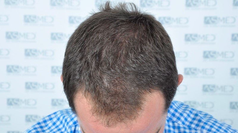 Norwood3 2625-grafts-FUE before 2