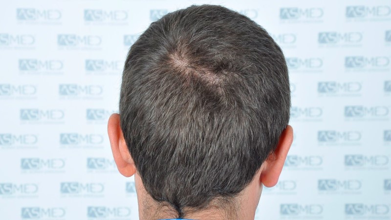 Norwood3 2625-grafts-FUE before 3