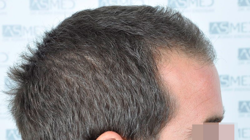 Norwood3 2625-grafts-FUE before 4