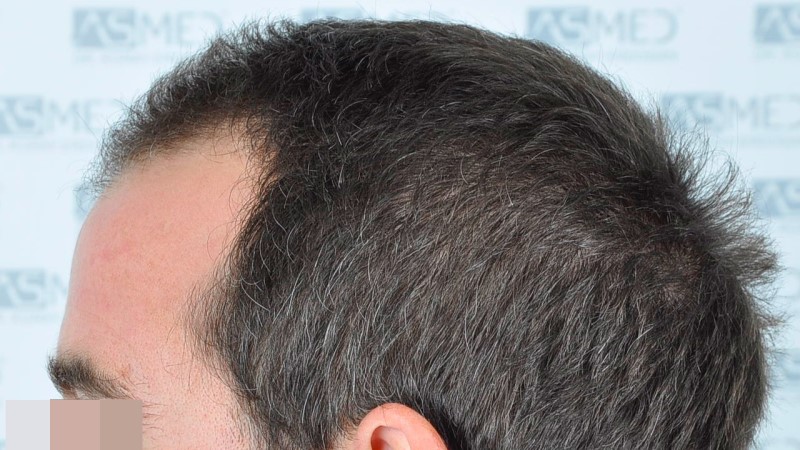 Norwood3 2625-grafts-FUE before 5