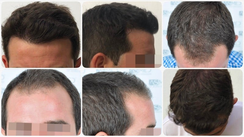 2625-grafts-FUE gallery