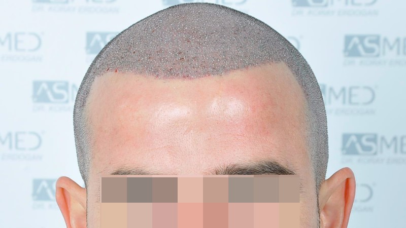 Norwood3 2625-grafts-FUE operation 1