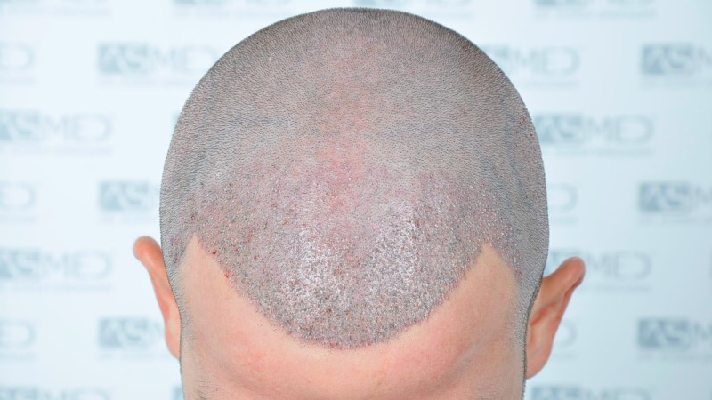 Norwood3 2625-grafts-FUE operation 2