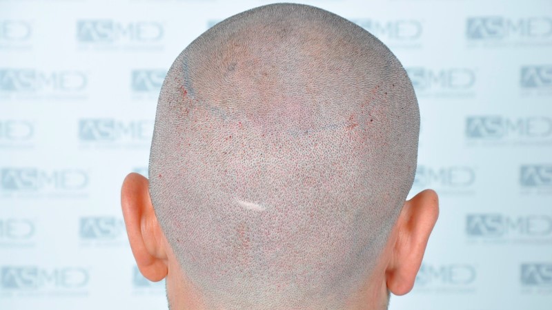 Norwood3 2625-grafts-FUE operation 3