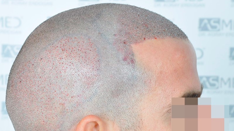 Norwood3 2625-grafts-FUE operation 4