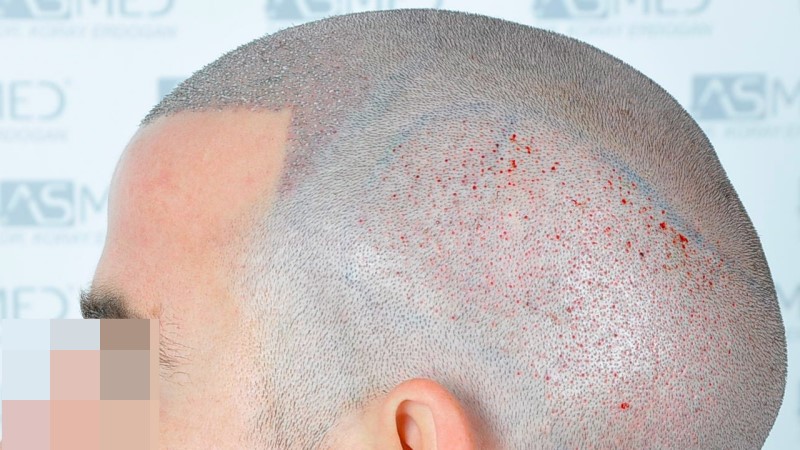 Norwood3 2625-grafts-FUE operation 5