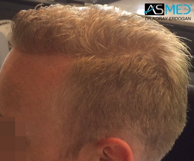 Norwood3 2810-grafts-FUE-Repair file_zps0daad385