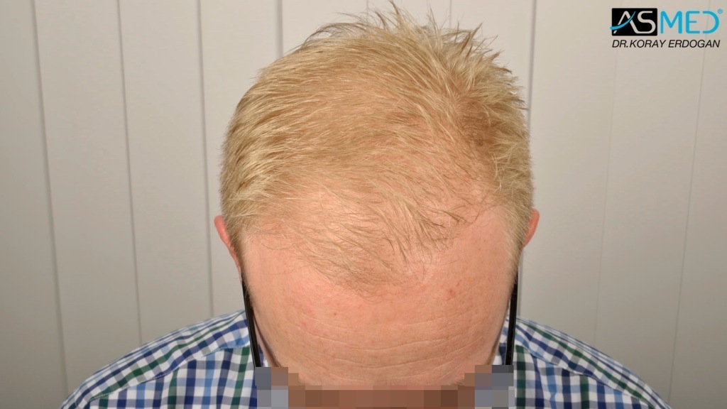 Norwood3 2810-grafts-FUE-Repair file_zps1f9a51d6
