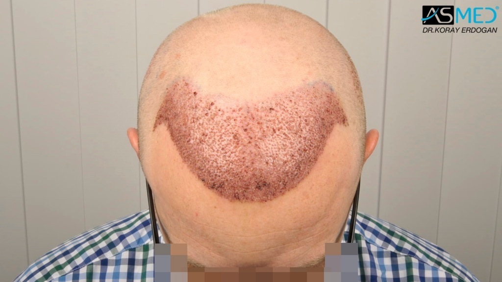 Norwood3 2810-grafts-FUE-Repair file_zps22a88652