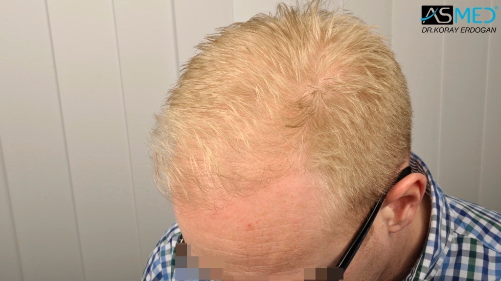 Norwood3 2810-grafts-FUE-Repair file_zps2641861f