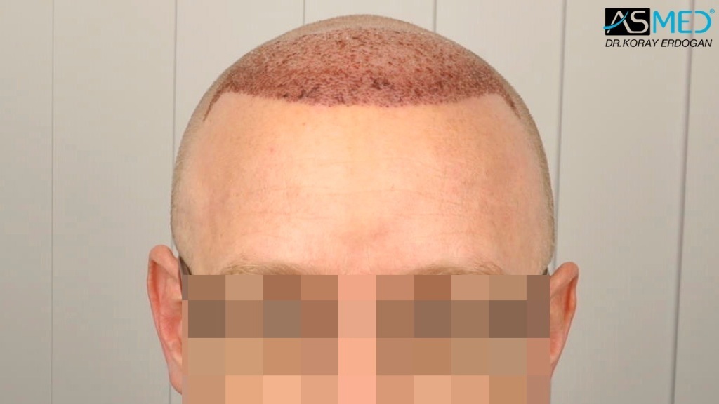 Norwood3 2810-grafts-FUE-Repair file_zps2c25d5b4