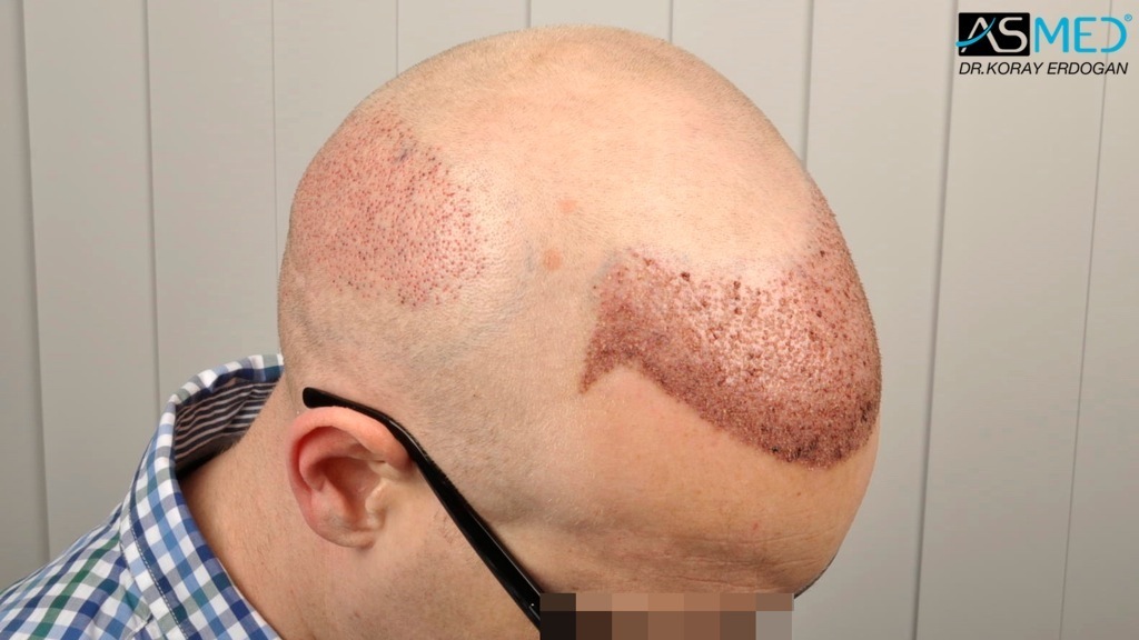 Norwood3 2810-grafts-FUE-Repair file_zps403c0200