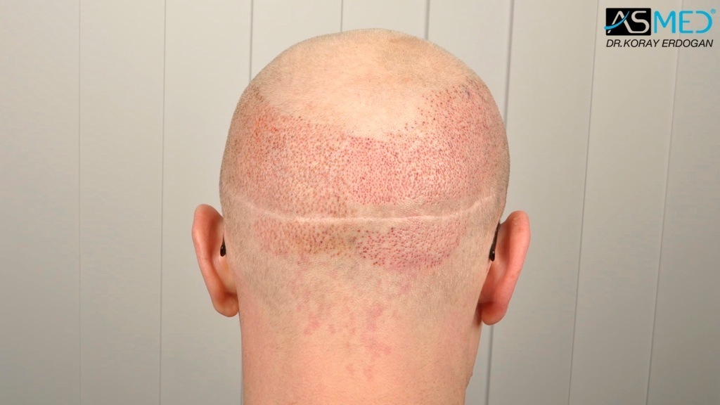 Norwood3 2810-grafts-FUE-Repair file_zps59f3c165