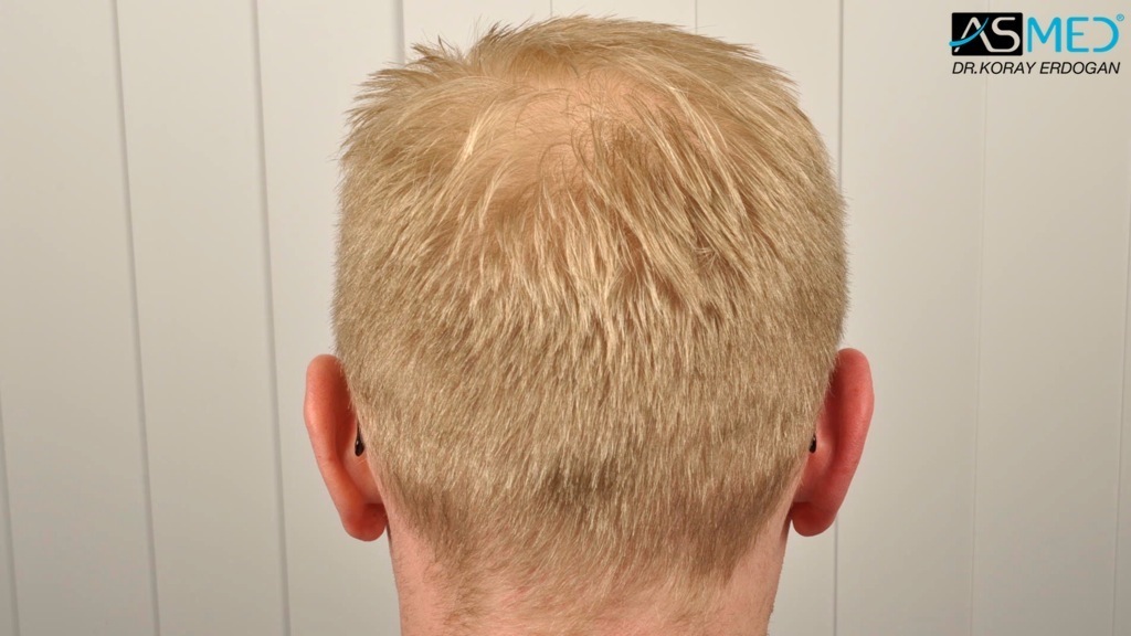 Norwood3 2810-grafts-FUE-Repair file_zps5e2073f7