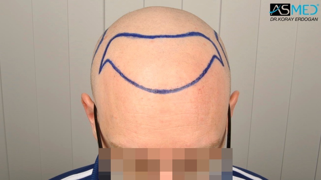 Norwood3 2810-grafts-FUE-Repair file_zps812a4735