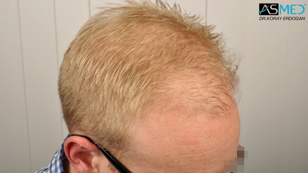 Norwood3 2810-grafts-FUE-Repair file_zps96bf4e91