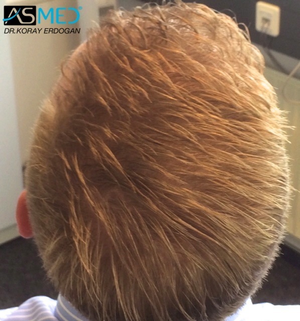 Norwood3 2810-grafts-FUE-Repair file_zpsbbd91b97