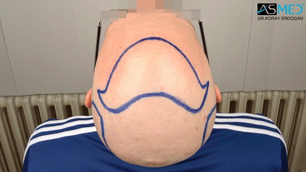 Norwood3 2810-grafts-FUE-Repair file_zpsd4870b25
