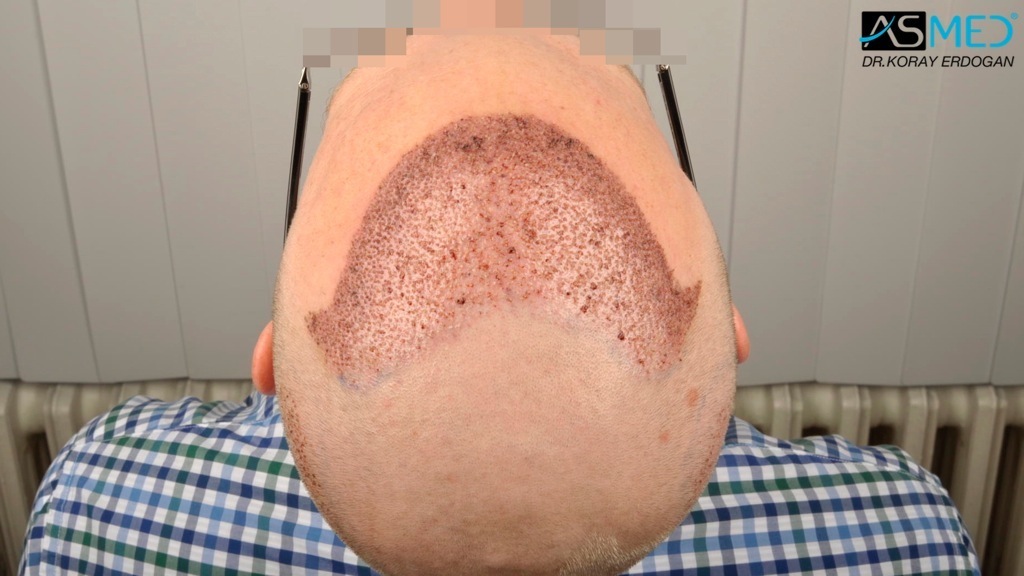 Norwood3 2810-grafts-FUE-Repair file_zpsea0404c2